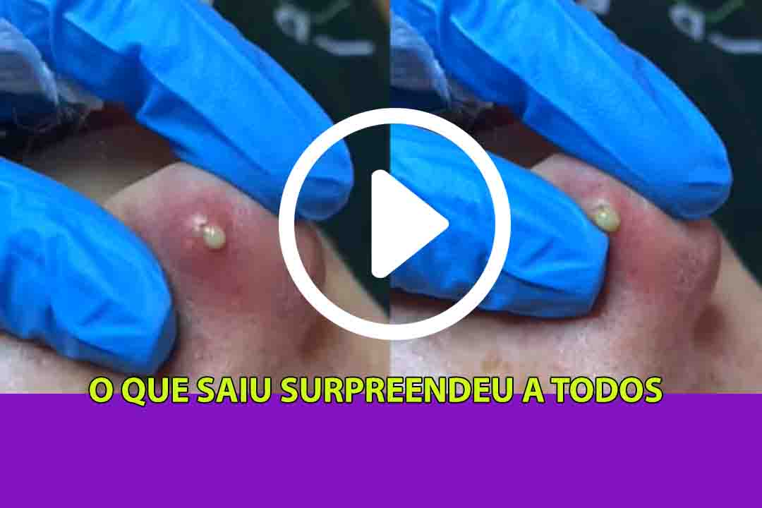 Meu Deus Nem Os Médicos Acreditaram No Que Saiu Daquela Espinha No Nariz; Veja Ao Vídeo