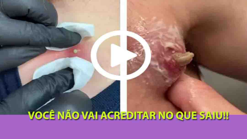 Removendo espinha GIGANTE do mamilo, você não vai acreditar no que saiu; Veja o vídeo