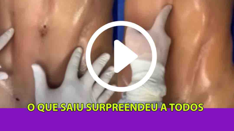 Você vai se surpreender como é retirada a gordura na barriga das mulheres; Assista ao vídeo