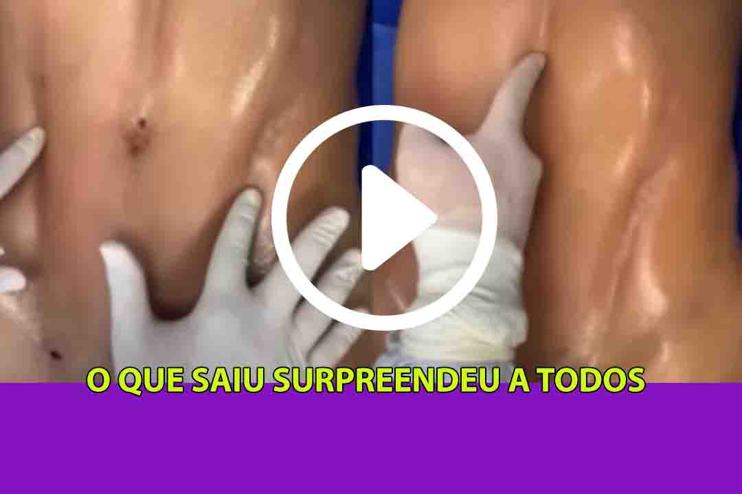 Você vai se surpreender como é retirada a gordura na barriga das mulheres; Assista ao vídeo