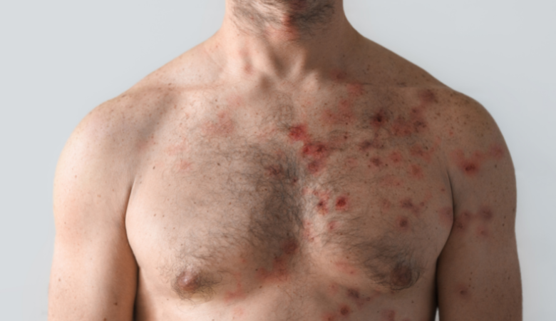 Ministério Da Saúde Alerta Para Onda De Monkeypox e hospitais quase entram em colapso, pessoas estão na fila fazendo… Ver Mais