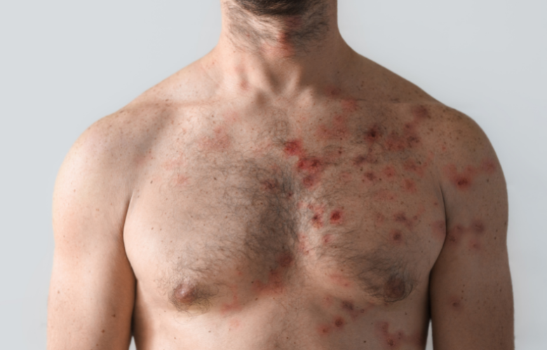 Ministério Da Saúde Alerta Para Onda De Monkeypox e hospitais quase entram em colapso, pessoas estão na fila fazendo… Ver Mais