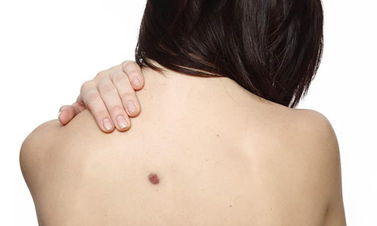 Fique de alert4  Se surgirem b0linhas vermelhas em seu c0rpo são sint0mas de…ver mais