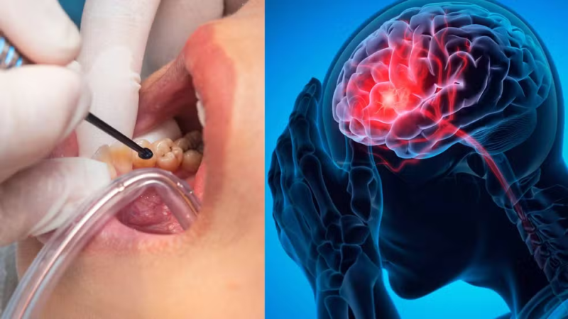 O que cárie e gengivite têm a ver com AVC?…Ver Mais