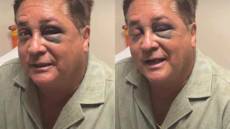 Leonardo sofre acidente e aparece com olho roxo foi uma picada de…Ver Mais