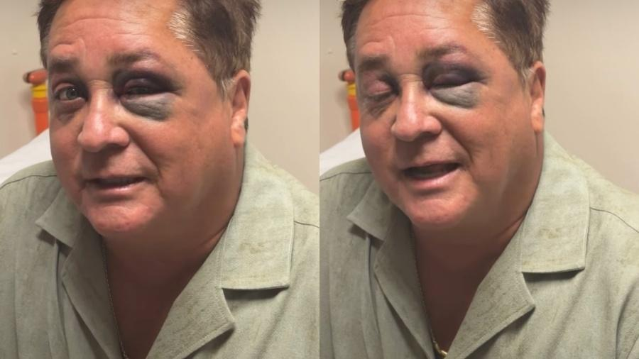 Leonardo sofre acidente e aparece com olho roxo foi uma picada de…Ver Mais